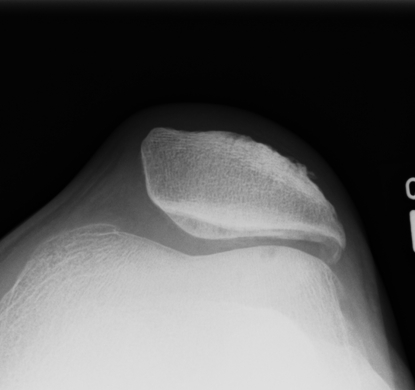 Patella Excessive Lateral Pressure 1